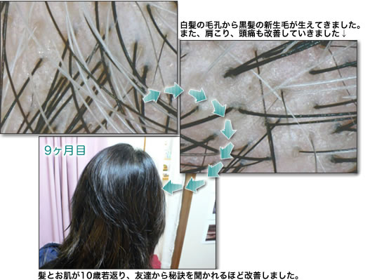 52歳女性 白髪の改善