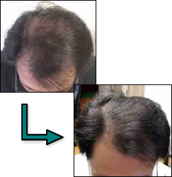 頭頂部の老化による薄毛