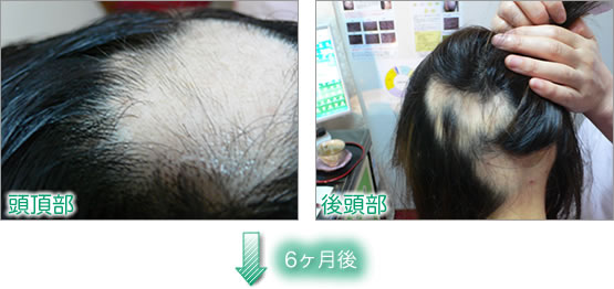男性型脱毛症　−円形脱毛症の改善−
