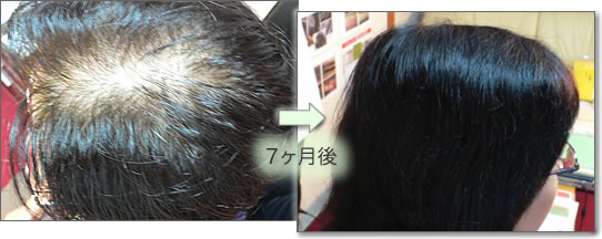 28歳女性 薄毛の改善