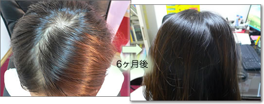 26歳女性 薄毛の改善