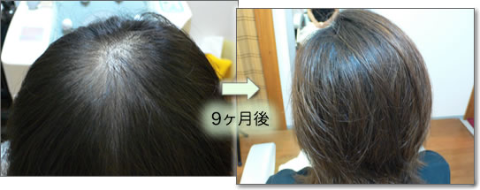 女性の薄毛 円形脱毛など 髪と頭皮の悩みを解決 名古屋aikei薬品