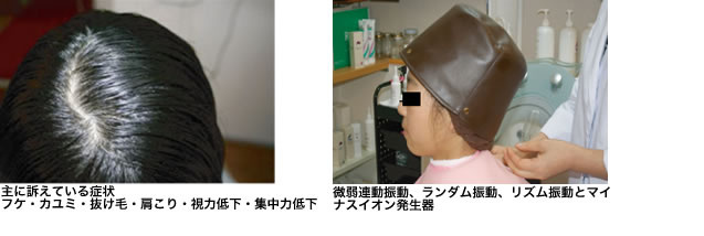 子供の薄毛 手当法1