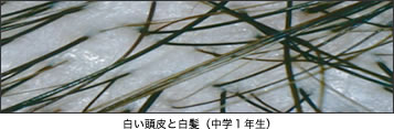 白い頭皮と白髪