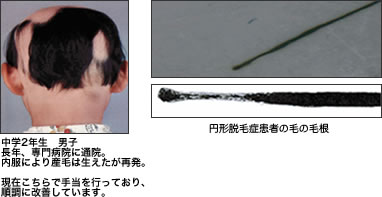 子供の円形脱毛症