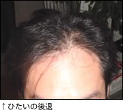 ひたいの後退