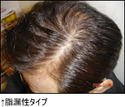 脂漏性タイプ