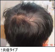 炎症タイプ