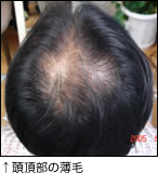 頭頂部の薄毛
